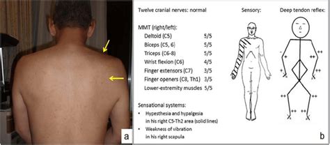 .with all muscle pain or any other internal pain — for instance, heart attacks are felt in the shoulder and arm — but the scalene muscles consistently the shoulder & arm, the pain of painful scalene muscles spreads throughout the chest, upper back & chest, the arm & hand & the side of the head. a) A picture of the patient's back. Muscle atrophy of the right... | Download Scientific Diagram
