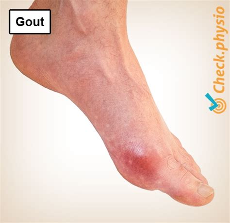 Gout Physio Check