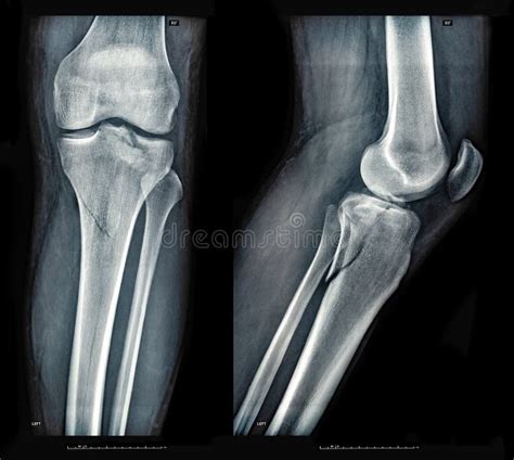 Xray Images Showing Real Fracture Of Leg Bone Under The Knee After