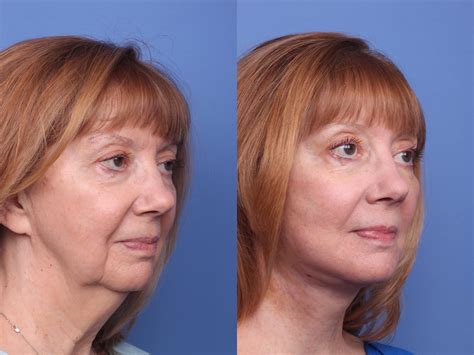 Facelift Recovery Time Phoenix And Scottsdale Az Dr Todd Hobgood