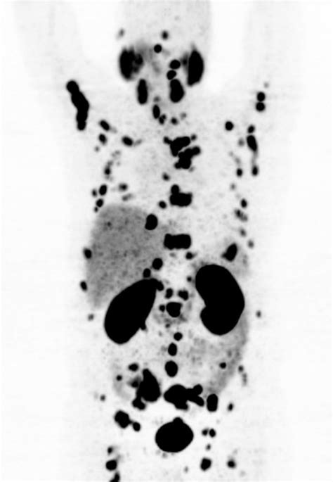 Baseline 68 Ga Psma Petct Scan With Multiple Bone Metastases And Lymph