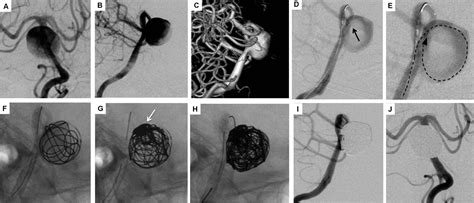 Stent Assisted Coil Embolization Of Intracranial Aneu