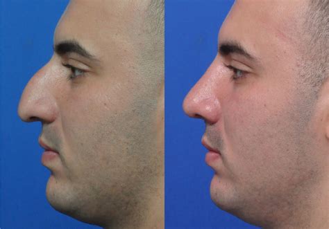 Why Male Nose Surgery Is So Popular Benefits