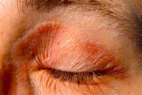 Eyelid Dermatitis Eczema Symptoms Causes And Treatmen Vrogue Co