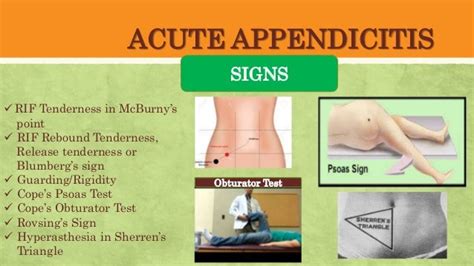 Acute Appendicitis Rlq Pain