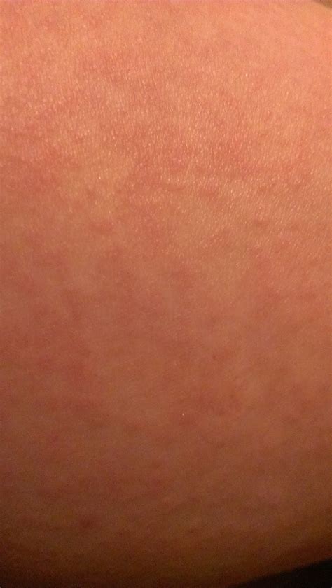 Another Day Keratosis Pilaris Update After 4 Days Of Treatment