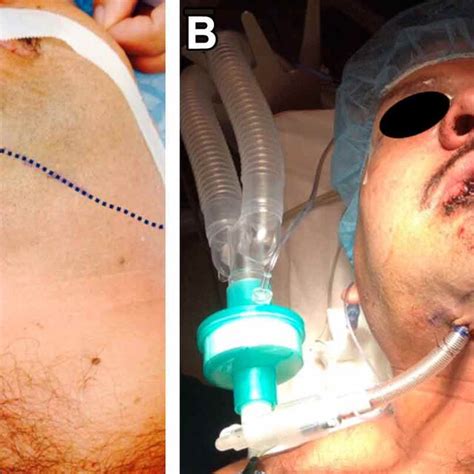 Submental Intubation A Mandible Border Blue Line Skin Incision