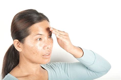 What Is The Best Way To Treat Melasma Clique Clinic