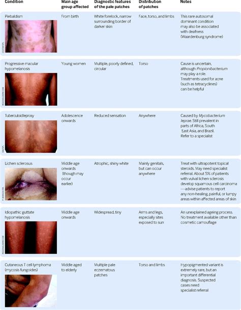An Approach To Hypopigmentation The Bmj