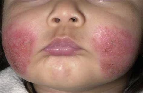 Study Medical Photos 1 Year Old Child With A Dry Itchy Rash On The Face