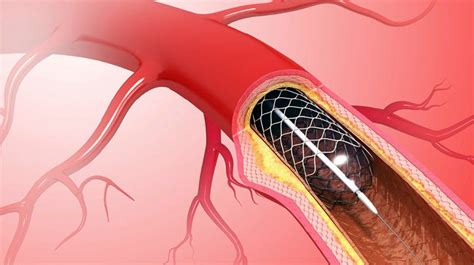 Review The Efficacy Of Heart Stents New Straits Times Malaysia