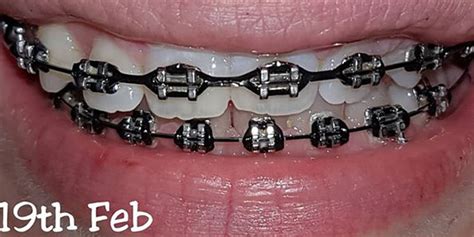 10 Smart Advantages Of Choosing Black Braces Braces Explained