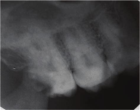 Periapical Radiograph Reveals Large Coronal Radiolucency Involving The
