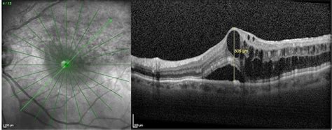 Edema A Mantellina E Esoftalmo - Occlusione venosa retinica • Dr Scarale