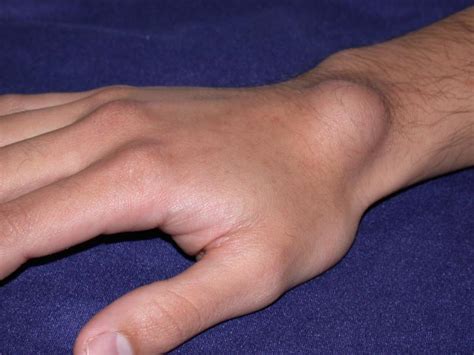 Ganglion Cyst Of Hand And Wrist Treatment By Raleigh Hand Center