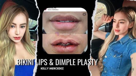 Bikini Lips Dimple Plasty DAYS Recovery YouTube