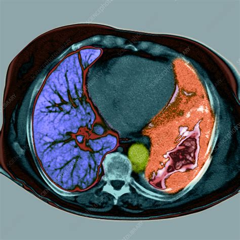 The scan only takes a few minutes and is not painful. Lung cancer, CT scan - Stock Image - M134/0562 - Science ...