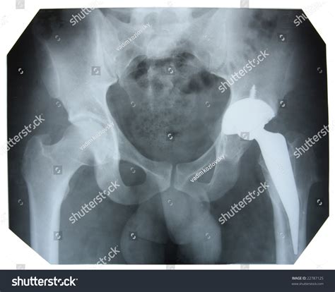 Xray Picture Showing Male Pelvis Artificial Stock Photo Edit Now 22787125
