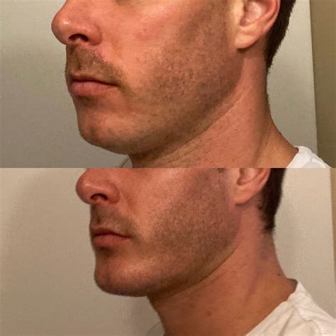insecure about my weak jawline / chin especially when I speak … any