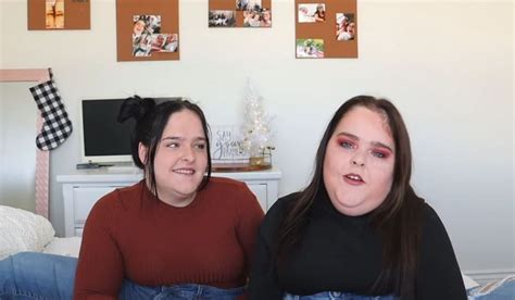 The Amazing Story Of The Connected Herrin Twins How They Look Now