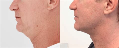 How Ultherapy Corrects Jowls And Sagging Skin Russak Plus New York