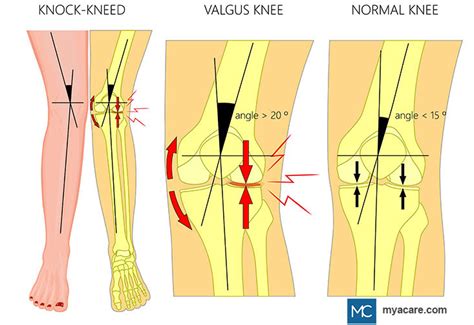Knock Knees Genu Valgum Symptoms Causes Diagnoses And Treatment
