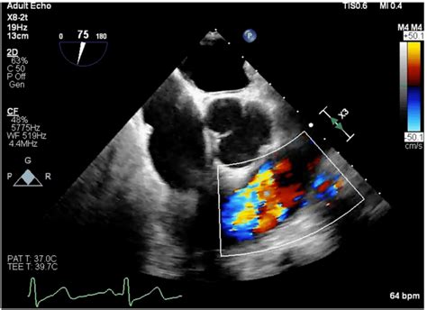 Midesophageal Right Ventricular Inflow Outflow Tee Color Doppler View