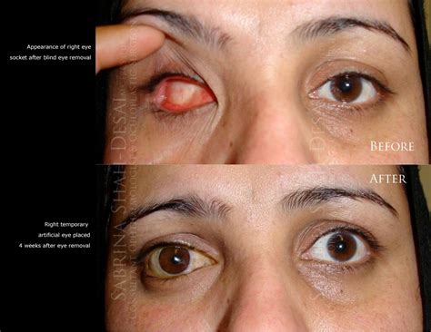 Blind Eye Removal Enucleation Evisceration Oculoplastic Surgeon Uk