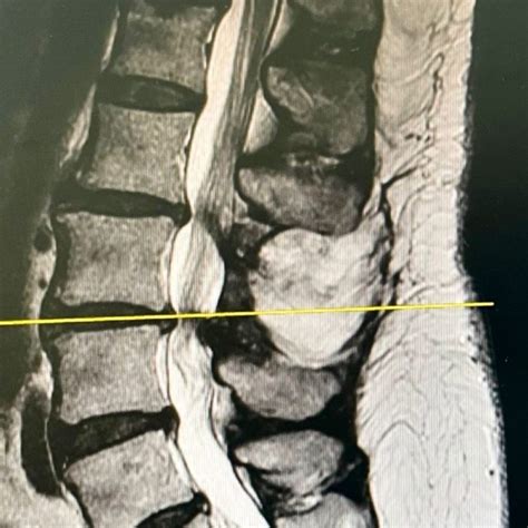Estenosis del canal espinal qué es síntomas y tratamientos VOTBLOG