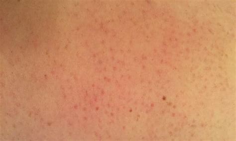 Why You Get Tiny Red Bumps On Your Arms And How To Get Rid Of Them