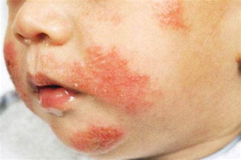 Rashes Around The Mouth Pictures Photos