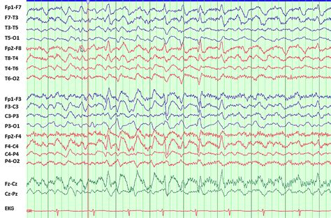 Cureus New Onset Non Convulsive Status Epilepticus Despite Cefepime