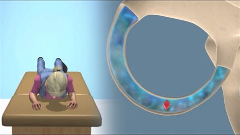 The epley maneuver for bppv particle repositioning. Lempert (BBQ) Maneuver to Treat BPPV Vertigo - YouTube
