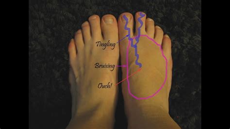 Dorsal Foot Pain Home Diagnosis And Treatment