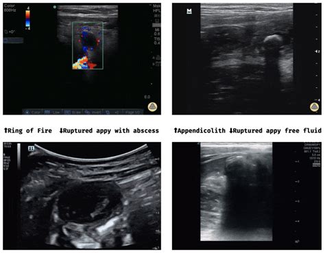 Sono Pro Tips And Tricks For Acute Appendicitis — Nuem Blog