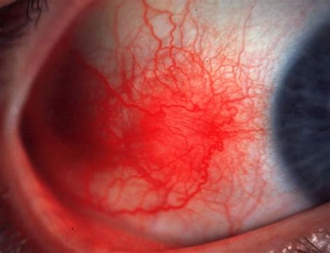 Ophthalmology Spot Diagnosis Nodular Episcleritis Epomedicine