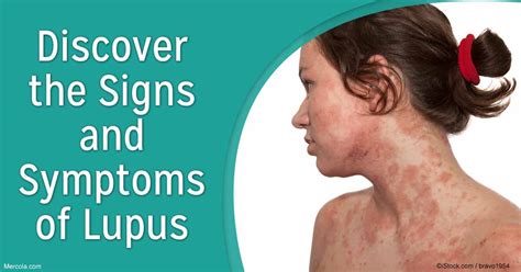 Discover The Signs And Symptoms Of Lupus