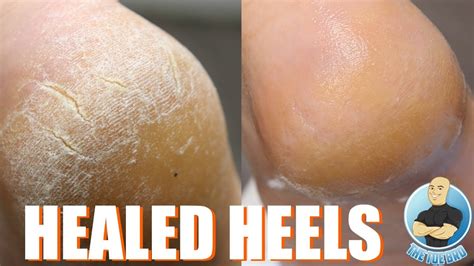 How To Treat Dry Cracked Heels Youtube