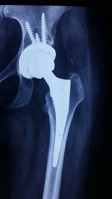 Which Is The Best Hip Replacement Option For Active Patients With