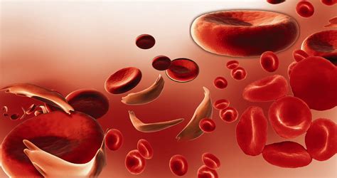 Anemia Falciforme Biosanas Serviços De Saúde