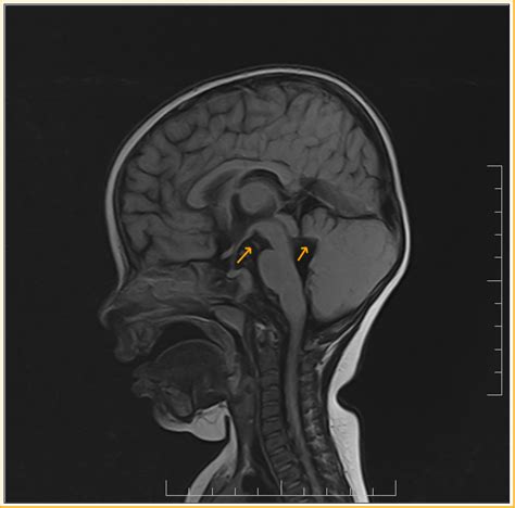 Jouberts Syndrome Mri Sumers Radiology Blog