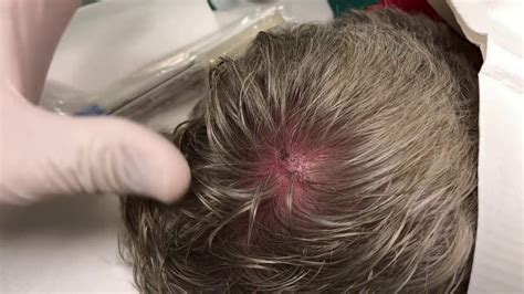 Big Scalp Cyst Or Spider Bite What Is It Youtube