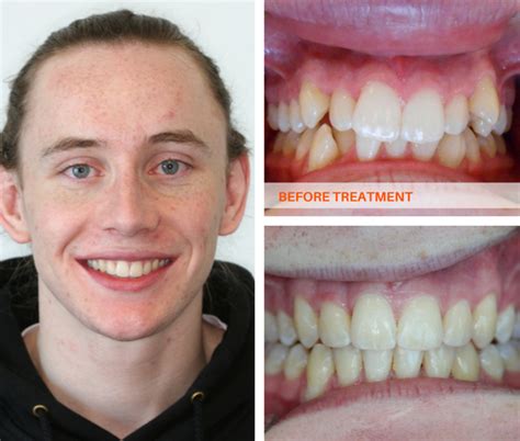 This blog extensively speaks of braces and how long they take to straighten your teeth, with eds playing a significant role in providing you the desired teeth you are looking for. Traditional Metal Braces - ismile