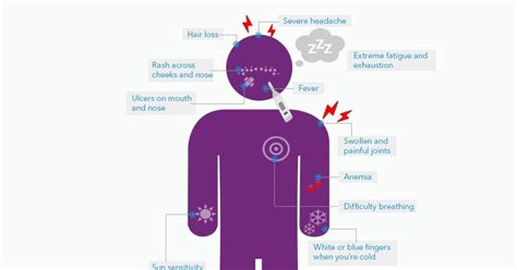 What Are The Symptoms Of Lupus Infographic