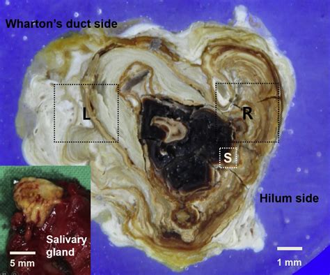 Characterization Of A Submandibular Gland Sialolith Micromorphology