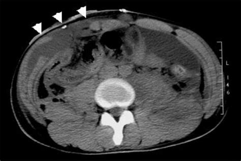 ct scan on the seventh postoperative day showing abscess formation with download scientific