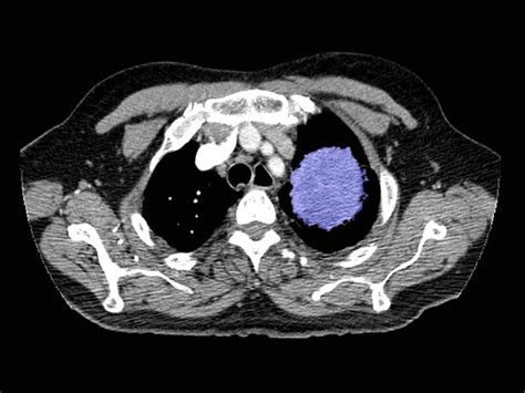 Ct scan showing a cancerous tumor in the left lung. Why Some Doctors Hesitate To Screen Smokers For Lung ...