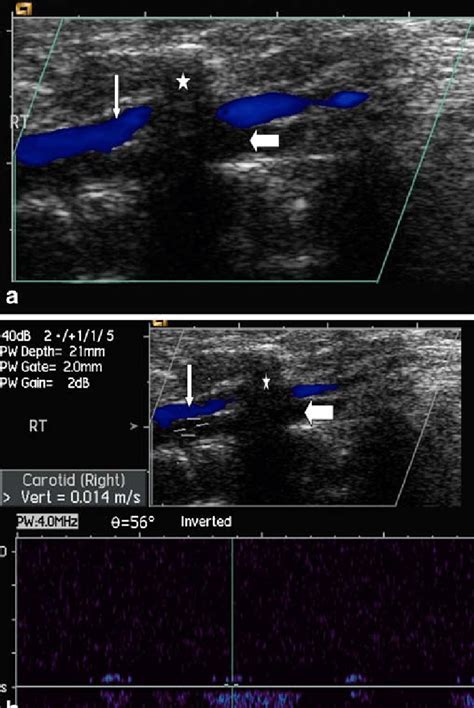 A Colour Doppler Ultrasound Us Demonstrates Absence Of Flow In The