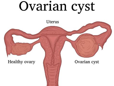 Sbb cyst ni ada banyak jenis, yang aktif, yang tidak, yang biasa, yang kanser, yang satu ketul, yang lebih dari satu ketul, yang fibroid, yang ada semasa preggy. Tanda Tanda Ada Cyst : Pengalaman Ada Ovarian Cyst Yang ...