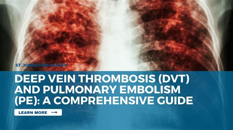 Deep Vein Thrombosis Dvt And Pulmonary Embolism Pe A Comprehensive